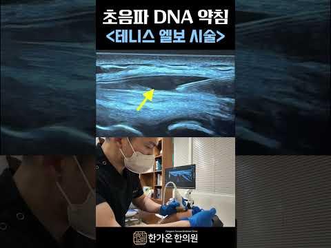 한가온한의원의 긴장감 넘치는 #초음파약침 #테니스엘보 #손목통증